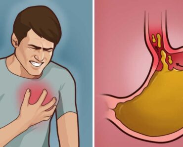 8+ natural ways to treat heartburn or acid reflux